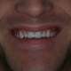 Non Prep Veneers-Hollywood Smile made...